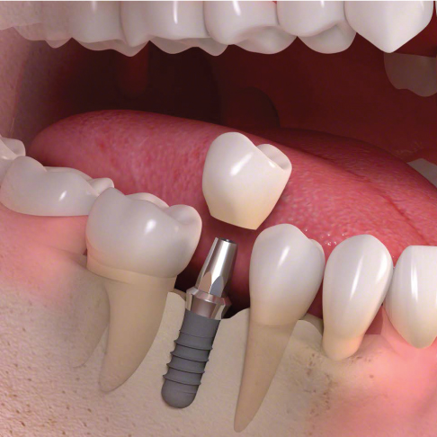 Guidance on the standards of care for NHS-funded dental implant